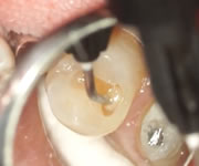 スピーディーにすきっ歯や虫歯を白く修復できる